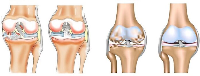 Artikulazioetako artritis (ezkerrean) eta artrosiaren (eskuinean) arteko aldea