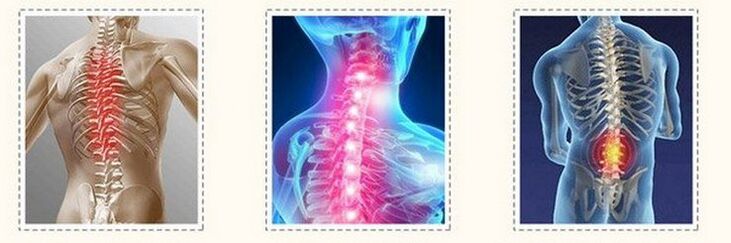 Bizkarrezurreko desberdinen osteocomondrosia