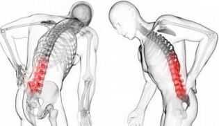 Hernia intervertebral - Osteokondrosiaren konplikazioa