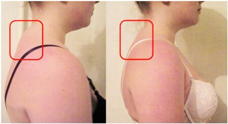Gihar arrabola eratzea osteochondrosis cervikarekin