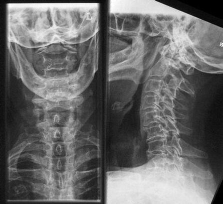 X -Rery X -Ray - osteochondrosisaren diagnostiko metodoa