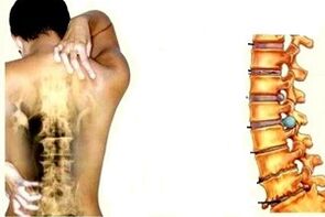 Bizkarreko mina, osteochondrosis cervikala garatzeko fase desberdinetan