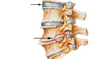 Bizkarrezurra normala eta hondatua, osteochondrosis cervikala