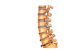 Bizkarrezurrean kalteak osteochondrosis cervikoarekin