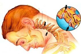 nerbioaren bizkarrezurra bizkarrezurrean osteochondrosis cervikoarekin