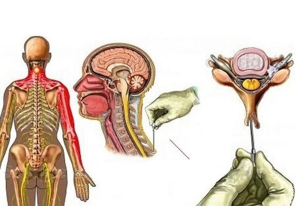 Osteokondrosi zerbikalaren tratamendua akupunturarekin