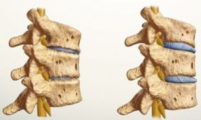 nolakoa da osteokondrosia