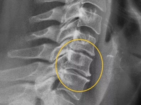 Trápaga bizkarrezurra osteokondrosia X izpietan